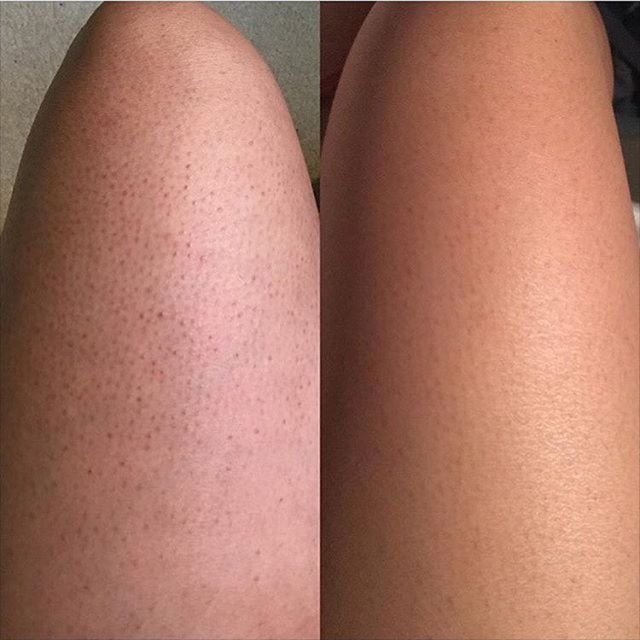 Smoother skin.